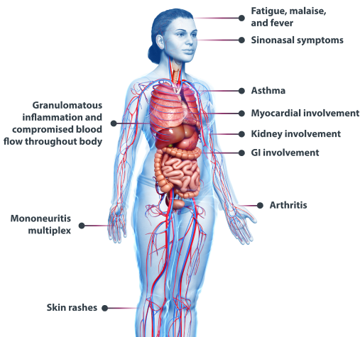 EGPA Clinical Manifestations